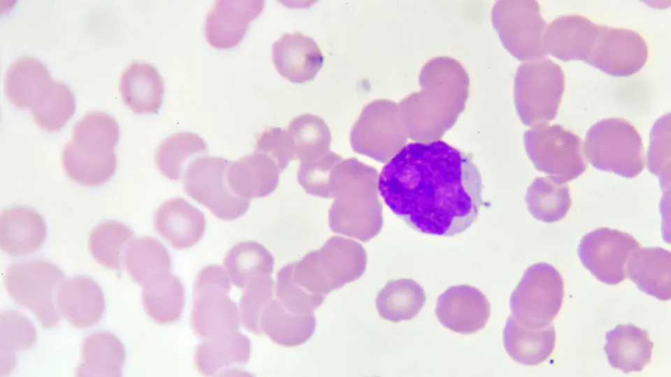 acute myeloid leukemia adalah